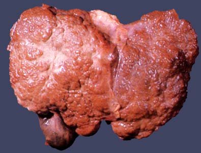 Anavar side effects on liver