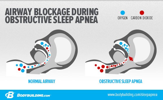 sleep apnea obstructive airway  how is sleep apnea prevention