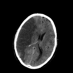 A CT Scan Slice Of The Brain Showing A Right-Hemispheric Ischemic Stroke.