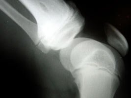 Osteoarthritis Is A Pain In The Knees, Hands, Spine, Hips, Or Any Joint.