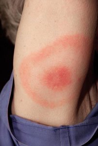 Get Treatment As Soon As Possible If You Believe That You May Have Lyme Disease.
