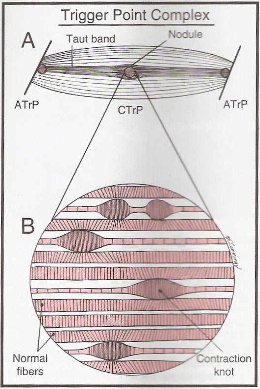 Trigger Point Complex Showing Contraction Nodules And Taut Band.