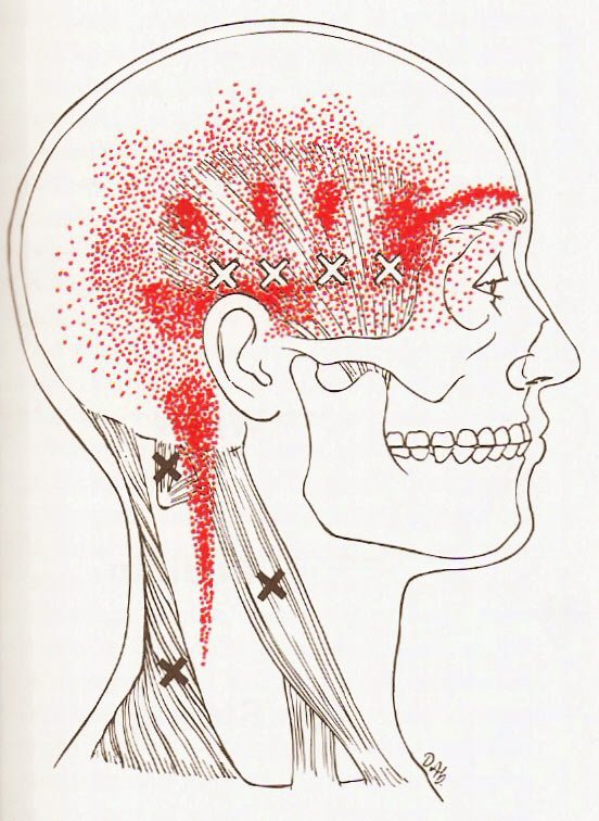 Trigger Point Massage Could Help Ease Your Headache Pain!